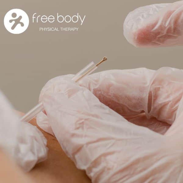 Physical therapist performing dry needling on a patient's shoulder at Free Body Physical Therapy in Chicago